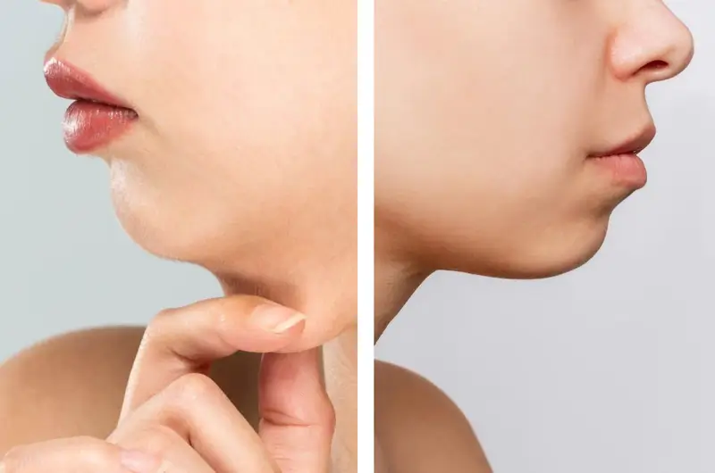 Nguyên Nhân Gây Ra Tình Trạng Cằm Lẹm Là Gì?