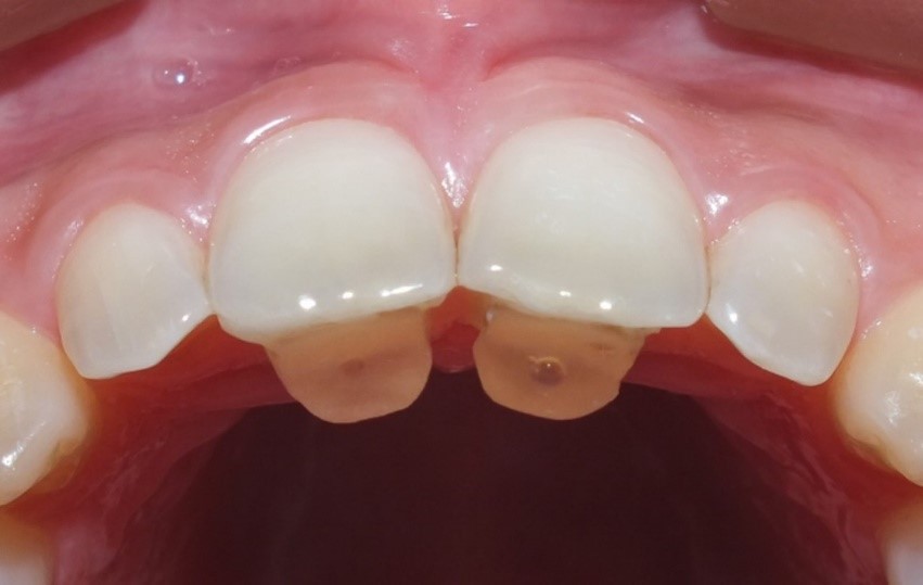 Nâng Khớp Cắn Trong Niềng Răng Là Gì? Quy Trình Và 5 Lưu Ý Sống Còn Các Phương Pháp Nâng Khớp Cắn Trong Niềng Răng Phổ Biến Nhất Hiện Nay