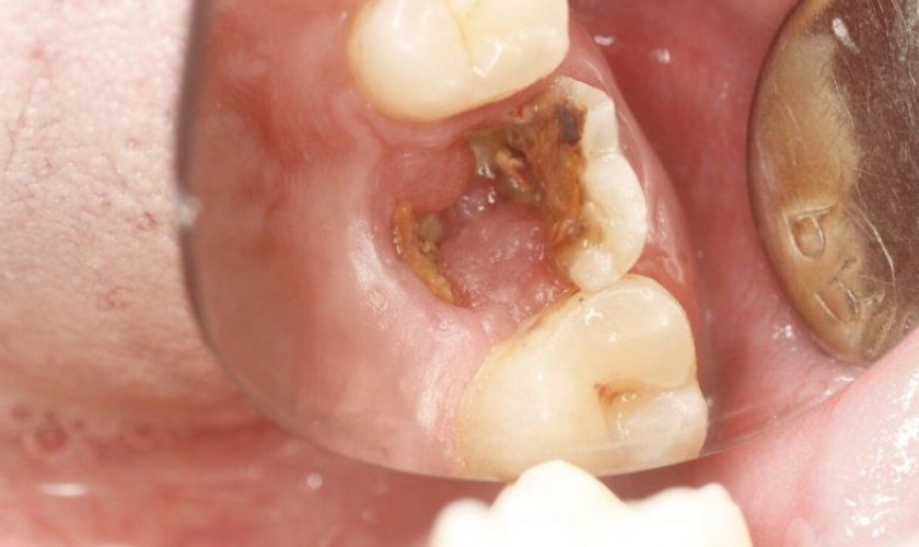 Răng Hàm Bị Sâu: Nguyên Nhân Và Cách Điều Trị Các Phương Pháp Điều Trị Răng Hàm Bị Sâu Hiệu Quả Nhất Hiện Nay