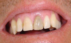 Răng Cửa Bị Đổi Màu: &Quot;Báo Động&Quot; Sức Khỏe Hay Chỉ Là Vấn Đề Thẩm Mỹ